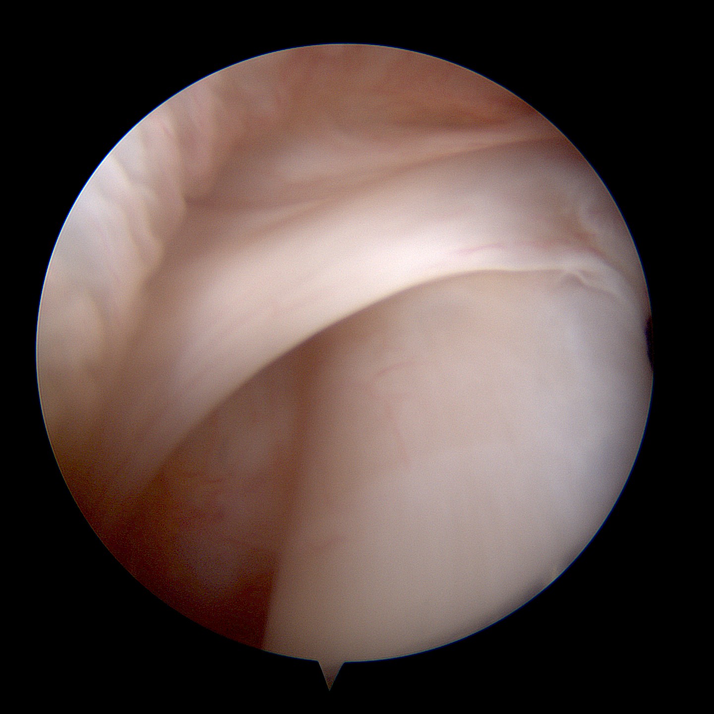 image arthroscopie sous scapulaire et le ligament glénohumérale moyen